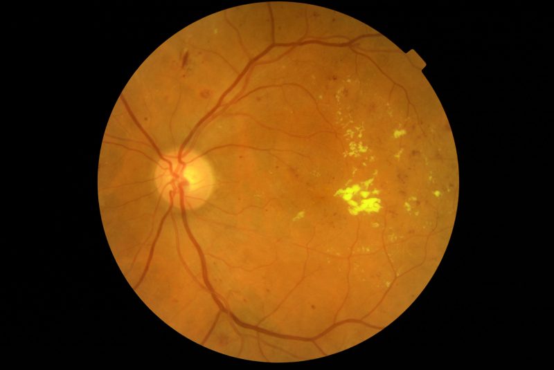 Pre-proliferative diabetic retinopathy