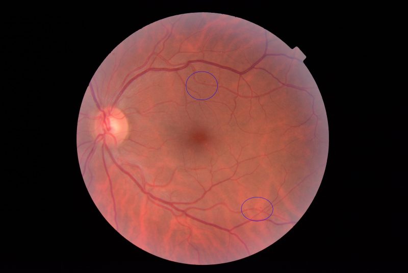 Background diabetic retinopathy