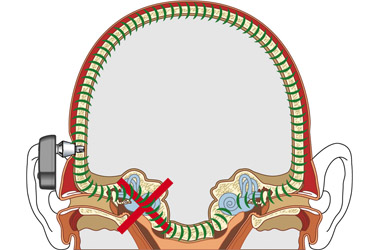 bone-conduction-hearing-devices-and-implants-bchds-and-bchis-south
