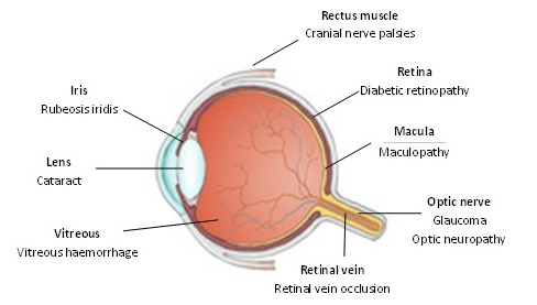 How diabetes can affect the eye
