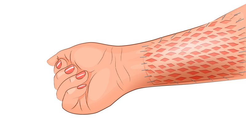 Illustration showing the the inner area of the arm above the wrist towards the elbow where a skin graft has taken place