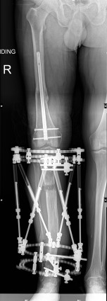 X-ray of left leg show limb reconstruction is required