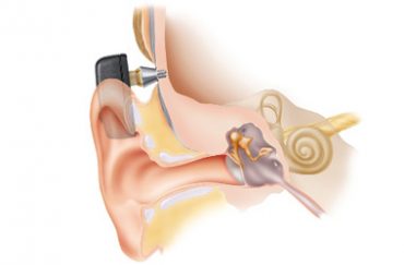 bone-conduction-implantable-solution-south-tees-hospitals-nhs