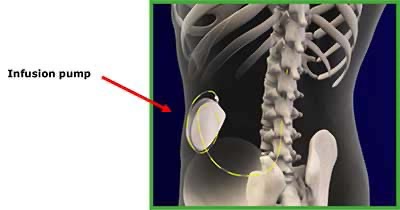 An implanted pump with tubing and catheter in position in the fluid filled spinal space