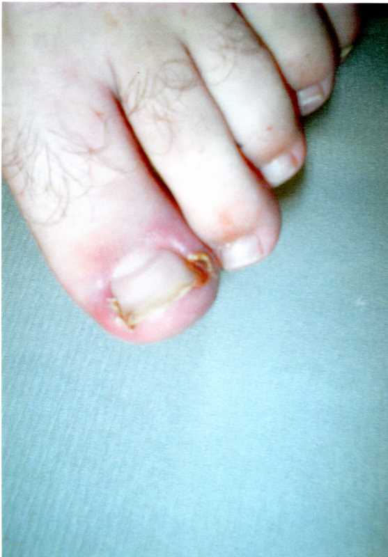 Ingrown toenail podiatry