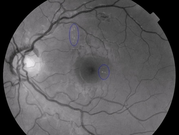 Maculopathy in digital surveillance.