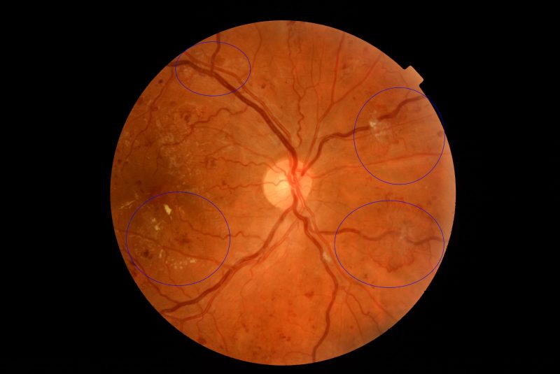 Proliferative diabetic retinopathy