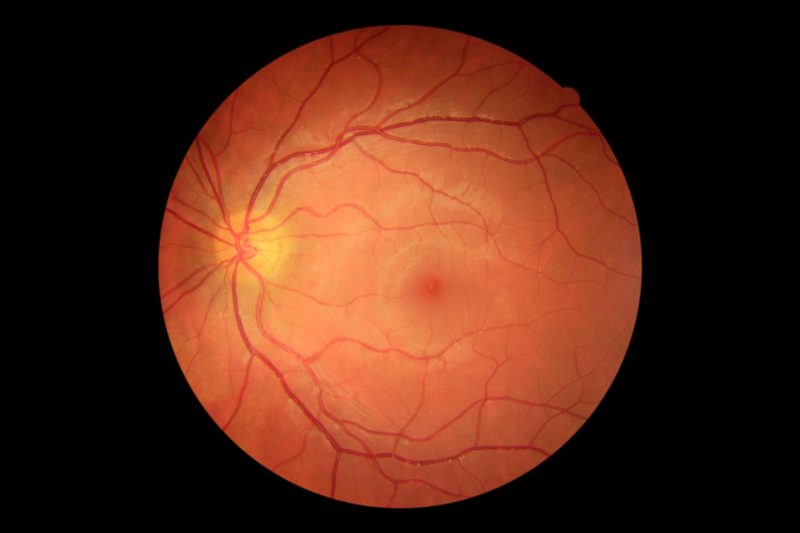 No diabetic retinopathy 