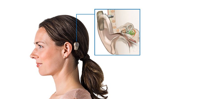 Image showing a lady wearing a bone conducting hearing device