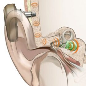 BCHD hearing system in an ear
