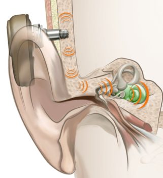 BCHD hearing system in an ear