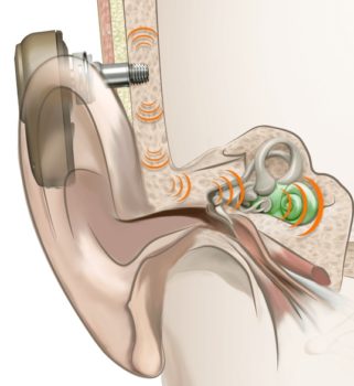 Thinking about a bone conduction hearing device South Tees