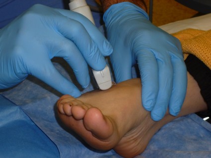 Intralesional bleomycin injection to the foot