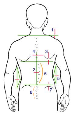 Diagram showing most common signs of scoliosis.