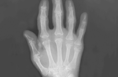 xray of the hand after surgery