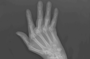 xray of the hand before surgery