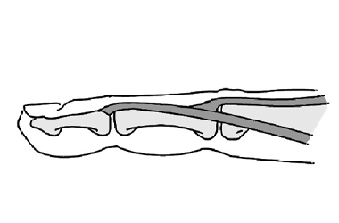 illustration of a normal central slip