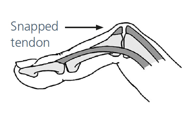 Illustration showing the position of finger with a central slip injury