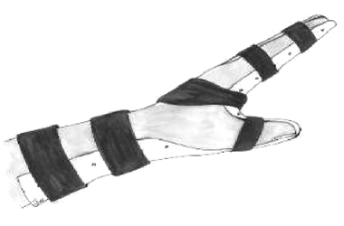 Extension splint example