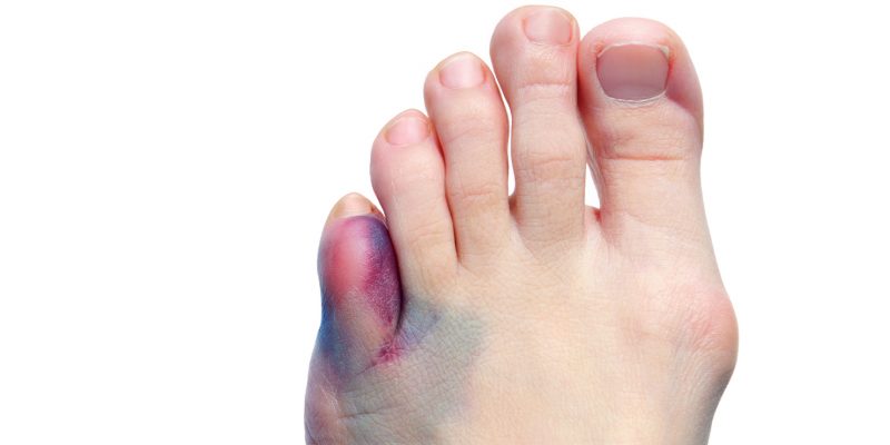 Image of a persons toes with the small toe all bruised