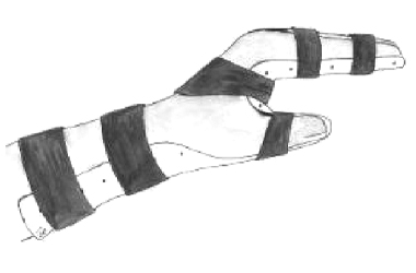 Flexion splint example