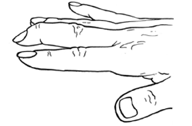 Line drawing of a hand. The middle finger is bent at the joint near th tip of the finger