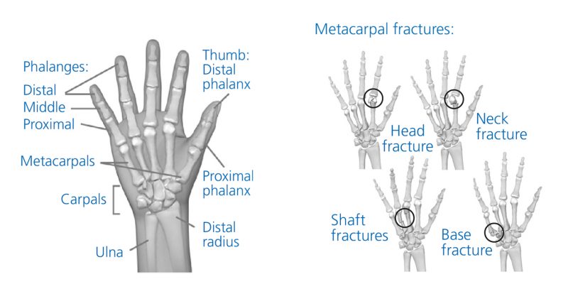 A diagram showing the bones in the hand and wrist with lines pointing to each of the different areas. and circled areas showing the different types of fractures