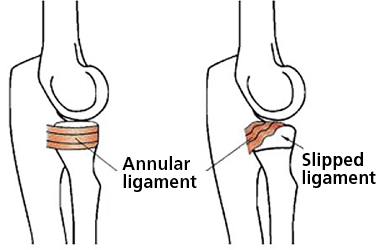 A diagram of the elbow joint. On the left side it shows the ligament how it would appear in a normal elbow joint and on the right hand side of the diagram it shows the elbow join when the ligament has slipped out.