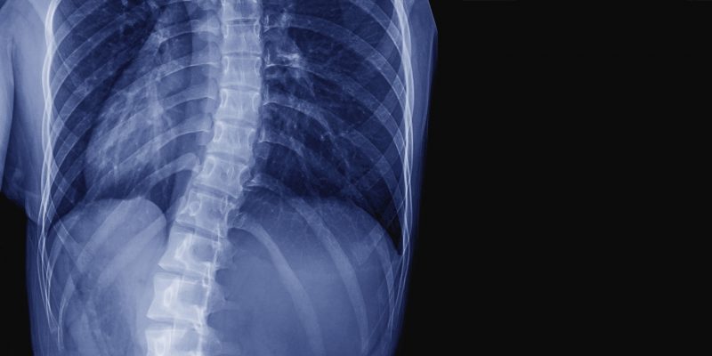 An xray of a curved spine