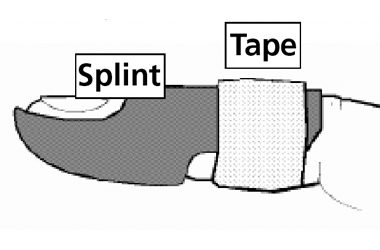 Diagram of a mallet finger splint highlighting the splint and the tape areas