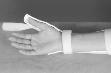 Hand in straight position in the splint