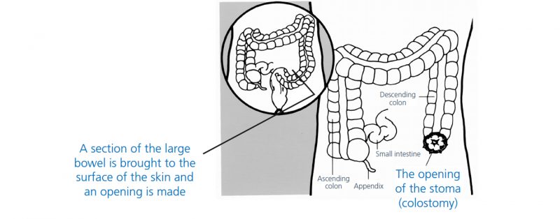 diagram illustrating where the opening of the stoma or colostomy would be