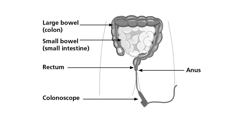 Diagram illustrating where the colonoscope will be inserted and the different areas of the bowel