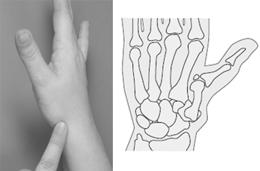 Hand showing us the area of the wrist where the pain is at its worst. Alongside this we have a digram of the hand illustrating the bones and the level of deformity in the thumb area