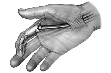 Medical illustration highlighting where the tendons from the wrist down to the fingers