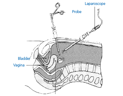 Diagram of the procedure