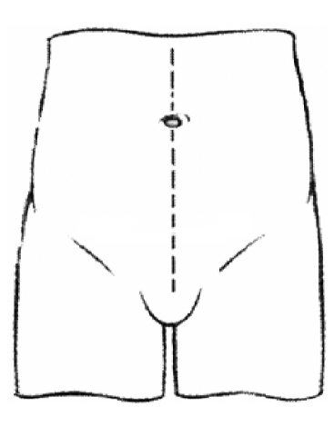 Illustration showing where the incision would be made on the abdomen