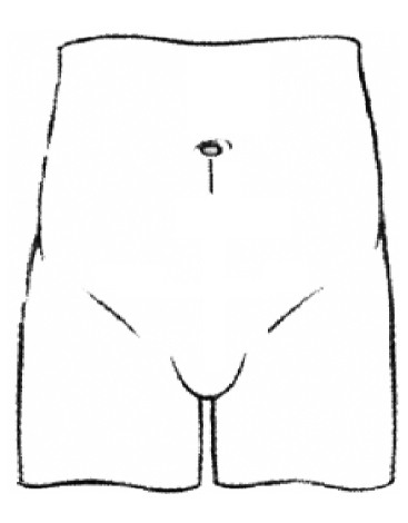 Illustration of the small incision line beneath the belly button