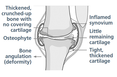 Diagram of a joint with osteoarthritis