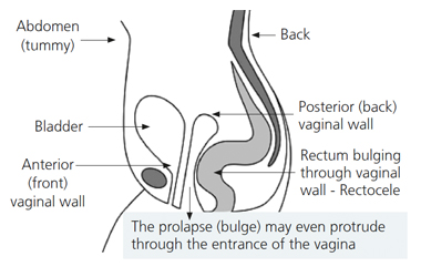 Diagram showing the vaginal wall and where the prolapse (bulge) may protrude