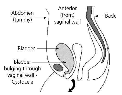 Diagram. (sideward view) showing bladder bulging through the anterior 
(front) vaginal wall (in standing women)