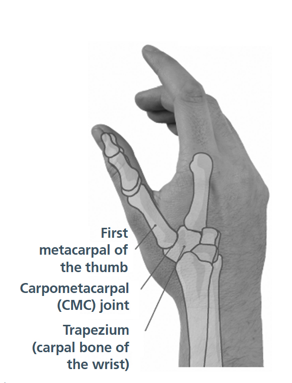 Osteoarthritis of the carpometacarpal thumb joint South Tees