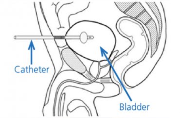 Suprapubic catheter insertion - South Tees Hospitals NHS Foundation Trust