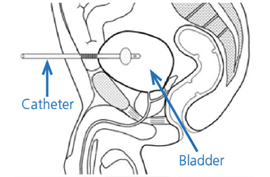 Line diagram showing the bladder area and where the catheter is inserted