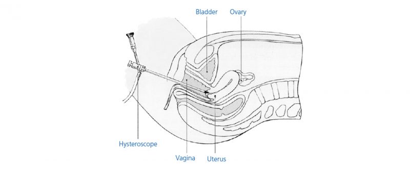 Hysteroscopy examination diagram