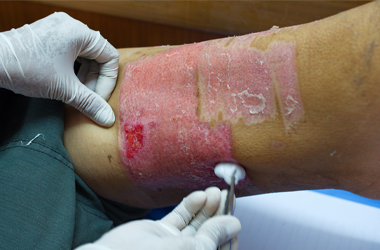 Image of the skin graft donor site