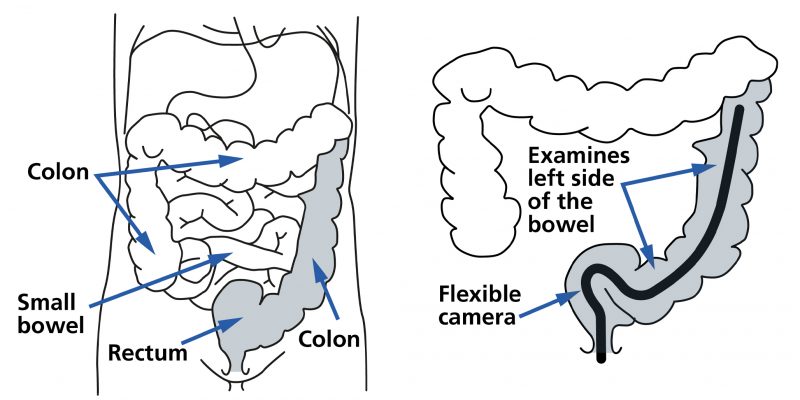 Diagram highlighting where the colon is located and where the flexible camera will be going