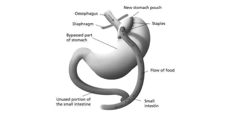 Diagram illustrating the area of the stomach that will be reduced