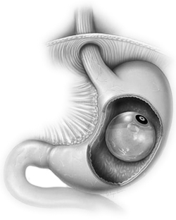 Illustration showing the balloon placed inside the stomach