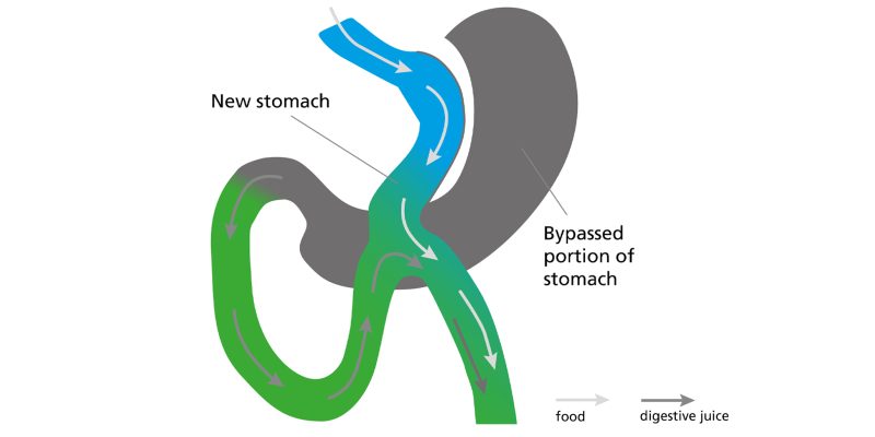 Diagram illustrating the areas of the stomach that will be bypassed